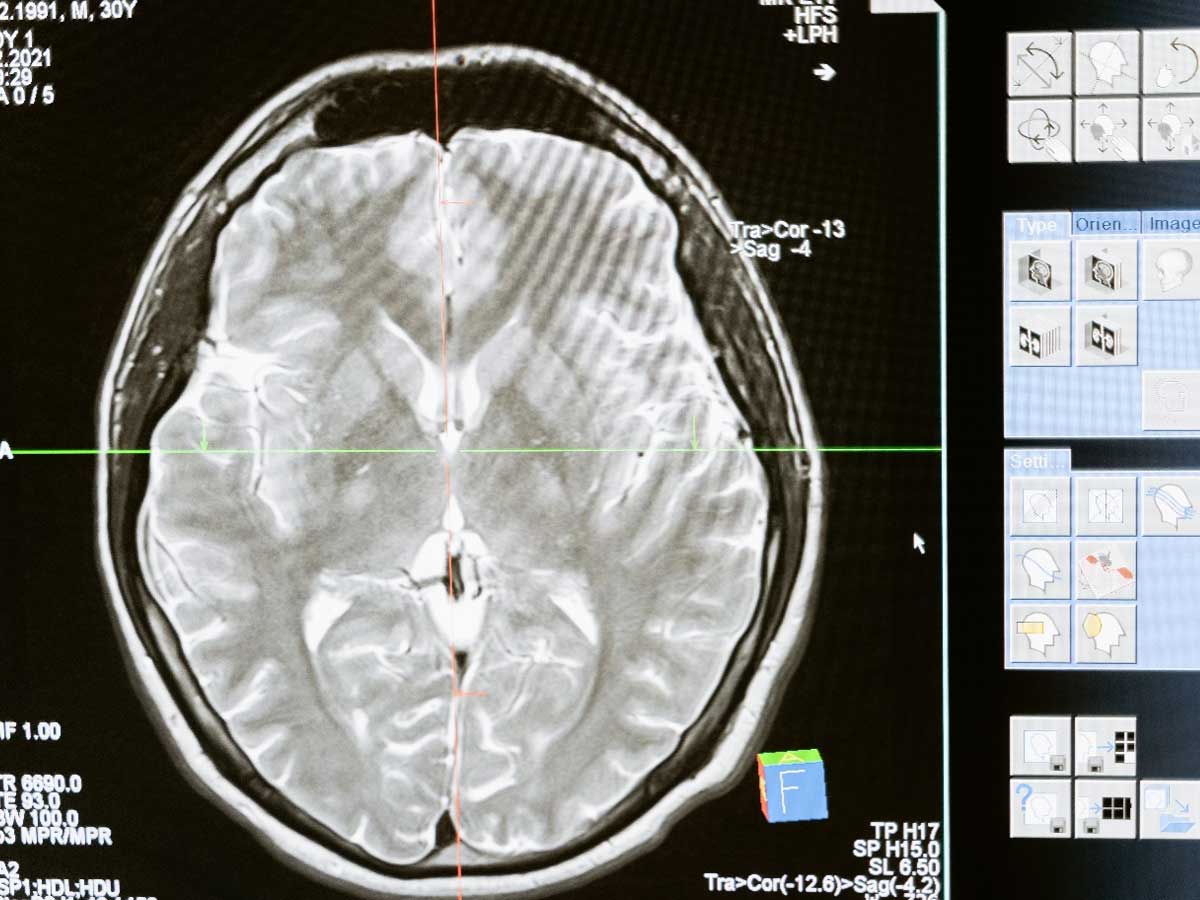 Featured image for “Brain Drain: 7 Serious Effects of Alcohol on Your Brain”